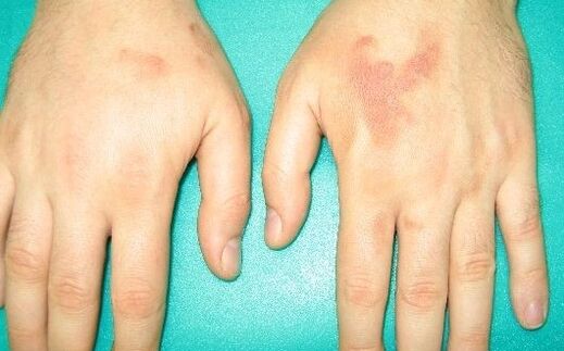 durerea în articulațiile mâinilor poate fi simptome ale paraziților