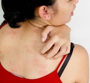 granuloame pe corp - simptome ale prezenței paraziților