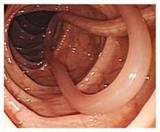 paraziți în corpul uman