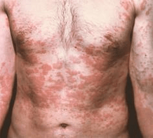 pielea problematică este un simptom al prezenței paraziților