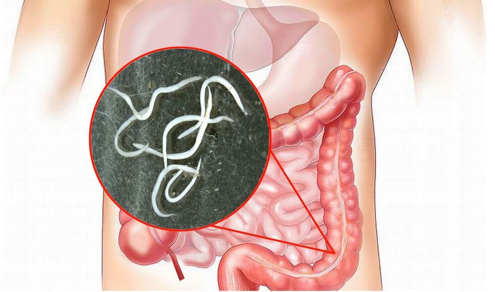 viermi în intestine