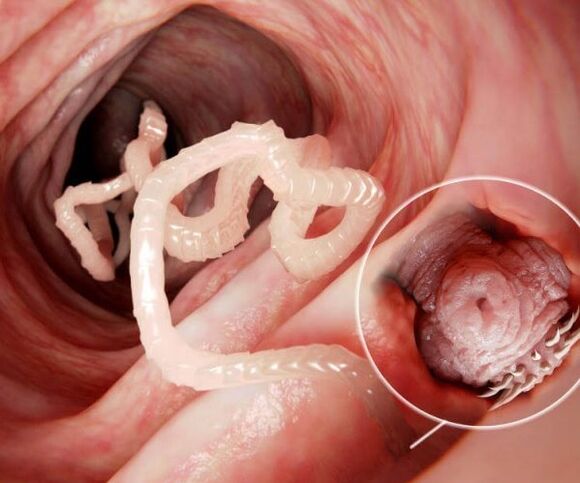 viermi în intestinul uman fotografia 2